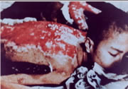 La espalda del entonces adolescente Sumiteru Taniguchi fue quemada de forma terrible tras el bombardeo nuclear de Nagasaki. (Foto cortesía del Museo de la Bomba Atómica de Nagasaki)